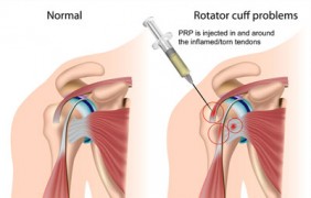 OrthoRepair-PRP